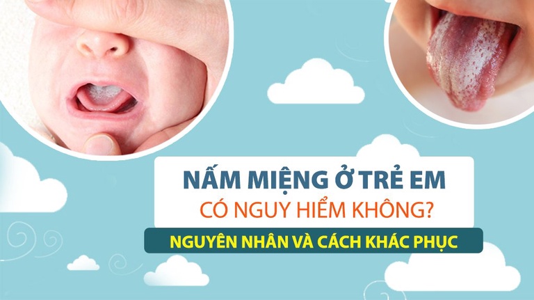 Nấm miệng ở trẻ em có nguy hiểm không? Nguyên nhân và cách khắc phục