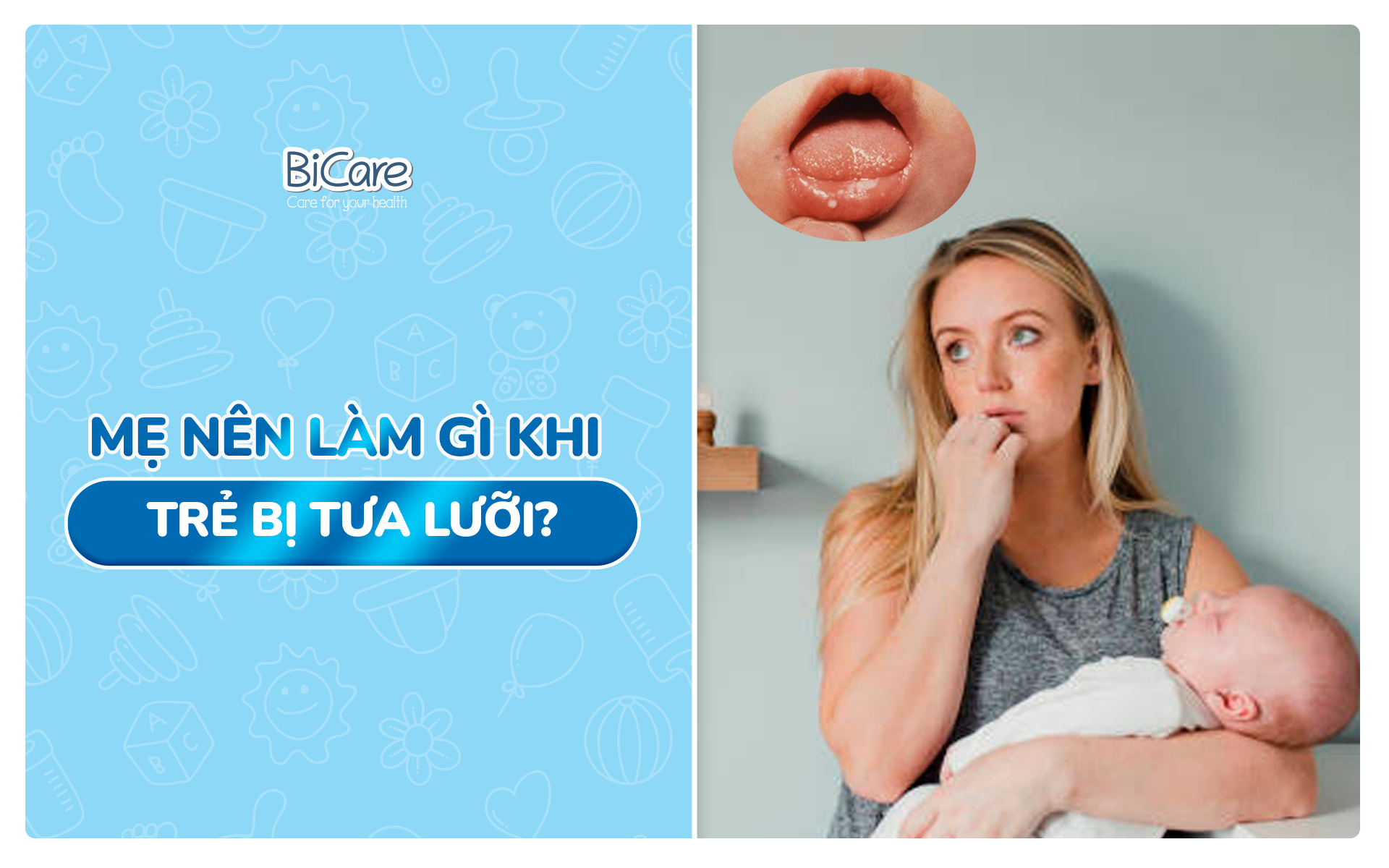 Mẹ nên làm gì khi trẻ bị tưa lưỡi?